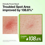 Anua Azelaic Acid 10 Hyaluron Redness Soothing Serum con complejo de té verde, aloe y centella