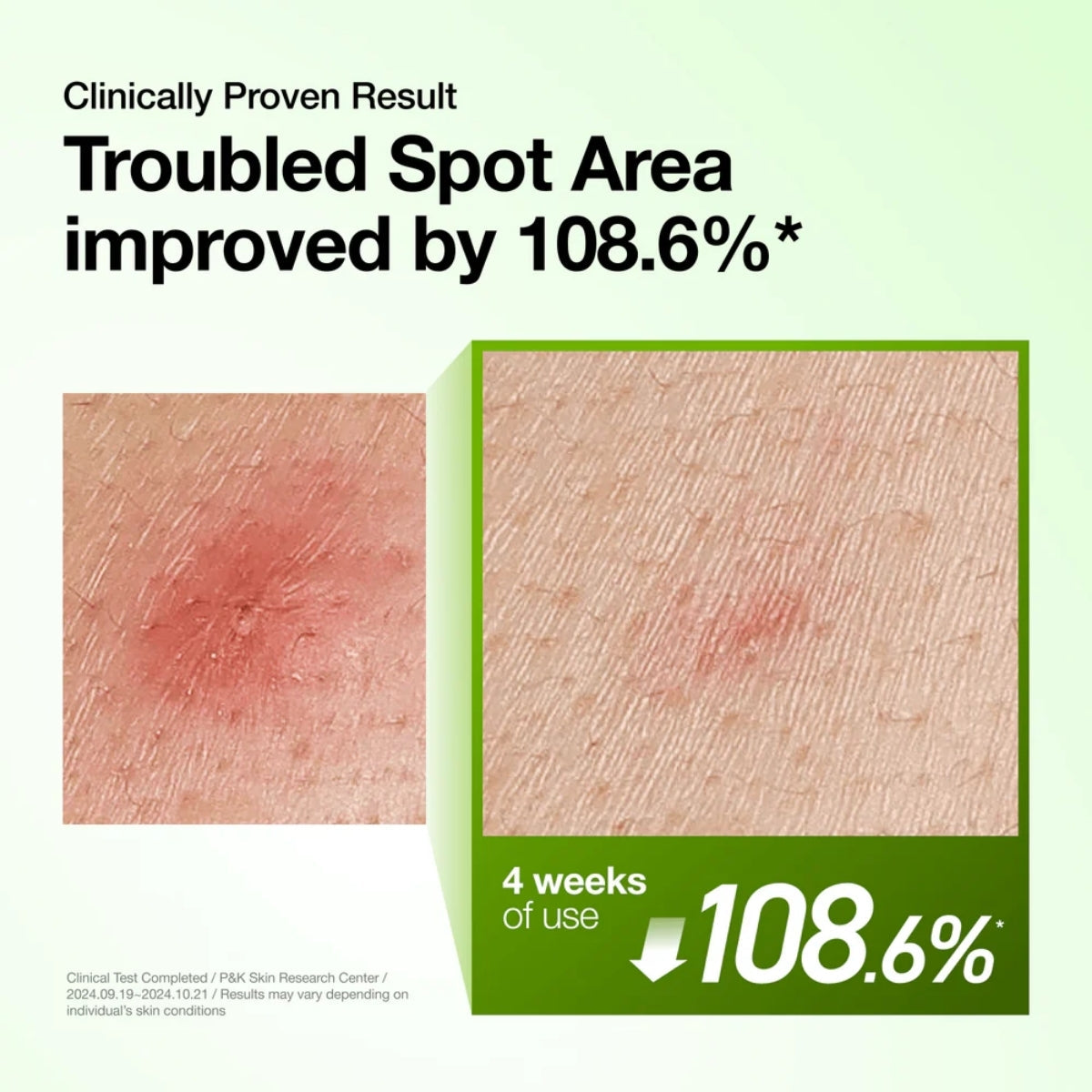 Anua Azelaic Acid 10 Hyaluron Redness Soothing Serum con complejo de té verde, aloe y centella
