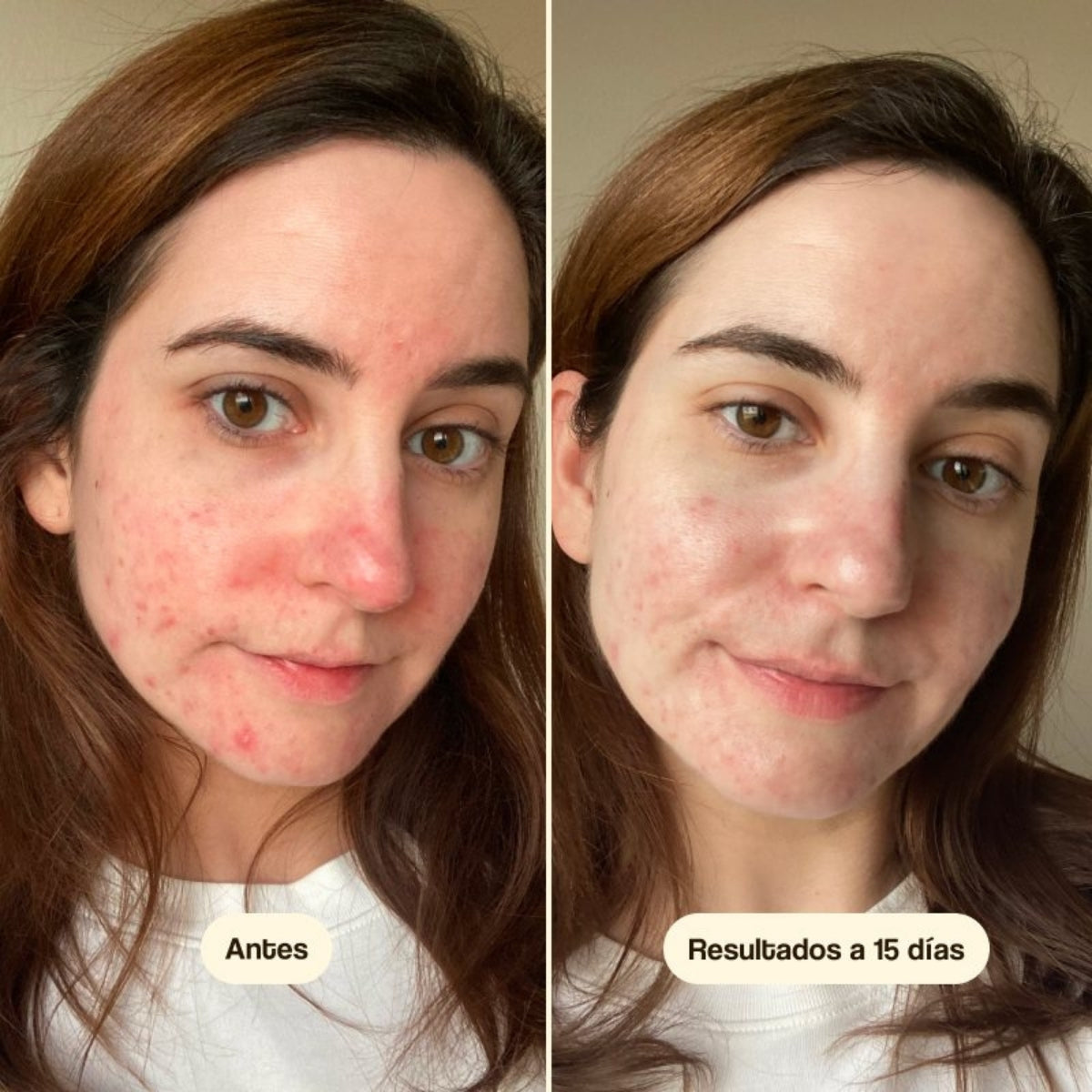 Freshly Cosmetics Azelaic Radiance Face Treatment, reduce los signos de acné, rosácea y cuperosis