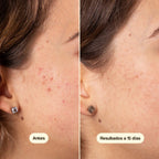 Freshly Cosmetics Azelaic Radiance Face Treatment, apto para piel sensible y reactiva